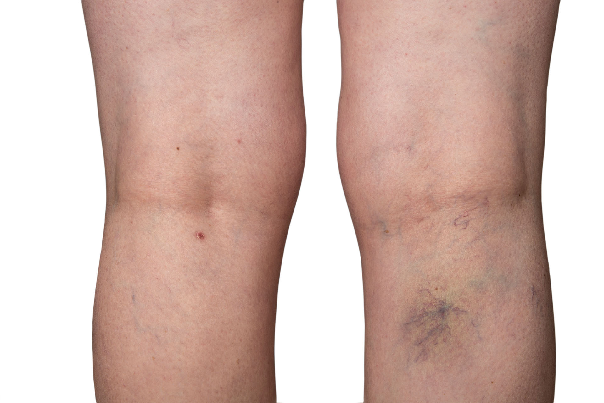 Bursted capillaries on a woman leg Cosmelan